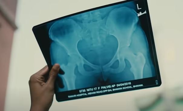 Nitu Ghanghas’s X-ray copy, showing her pelvic injury