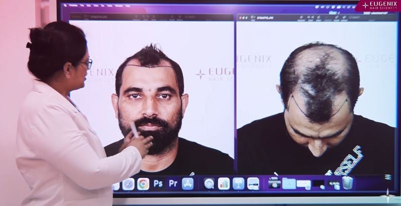 A plastic surgeon explaining the procedure of Mohammed Shami's hair transplant
